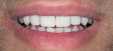 Bildnachweis für: Veneers-nachher