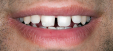 Bildnachweis für: Veneers-vorher