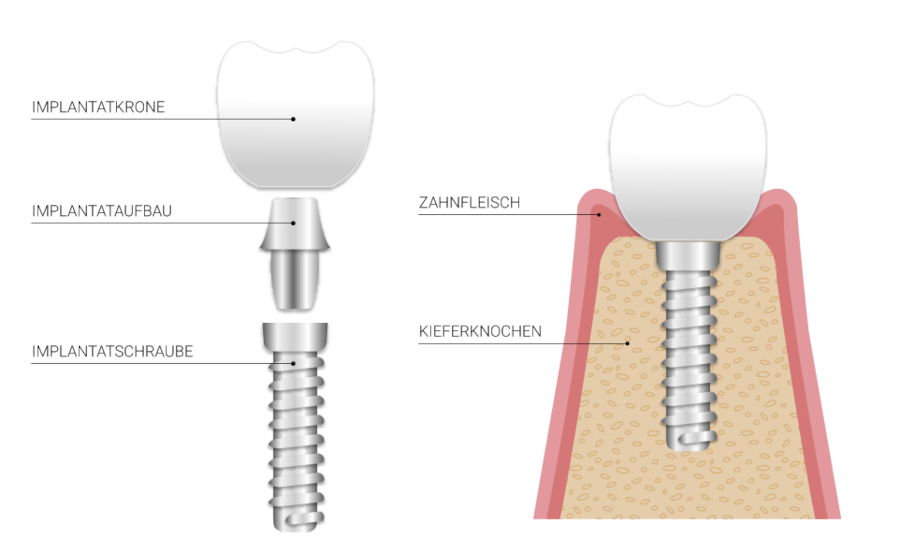 Zahnimplantate Grafik