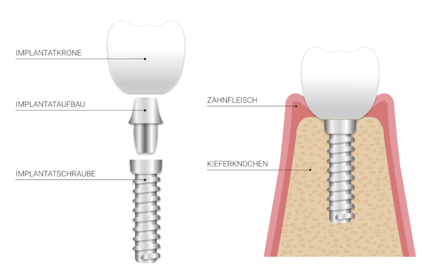 zahnimplantate-grafik